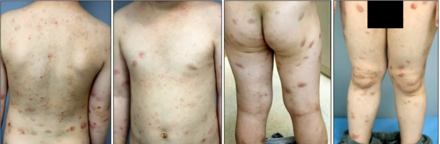 Fig. 2. Seven weeks after initiation of treatment with methotrexate, substantial improvement of the patient's atopic eczema was noted.