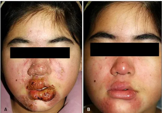 Fig. 1. (A) Erythematous plaques  and clustering pustules on both  lateral side of the nose with central clearing and peripheral extension,  involving lips