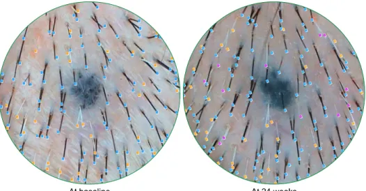 Fig. 1. An example of counting new gray hair developed during the  treatment using the phototrichogram analysis