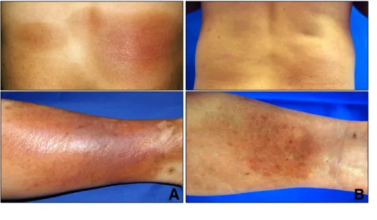 Fig. 1. (A) Edematous dusky red to erythematous patches on the back  and the left leg before treatment.