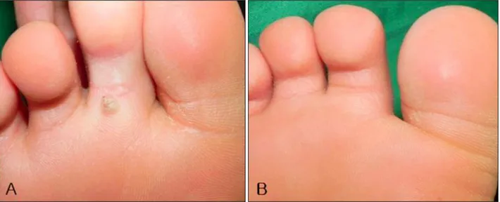 Fig. 1. Common warts before (A) and after (B) treatment with imiquimod 5% cream and duct tape occlusion therapy: complete response.