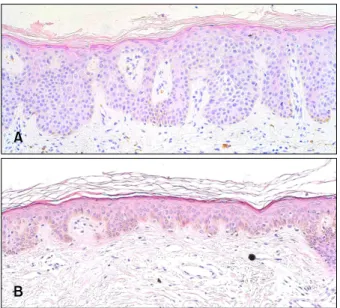 Fig. 2. Histological clearance of Bowen disease following pre- pre-treatment with a ablative CO 2  fractional laser following methyl  aminolevulinate-photodynamic therapy (MAL-PDT) (H&amp;E, ×200).