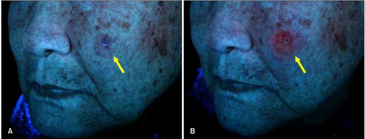 Fig. 3. Fluorescence assessment of the lesion (arrows). (A) Before application of photosensitizer, (B) after 70 minutes as incubation time.