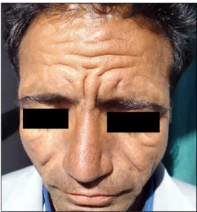 Fig. 5. Histopathological examination showing hyperplasia epi- epi-dermal and epi-dermal changes (H&amp;E, ×10).