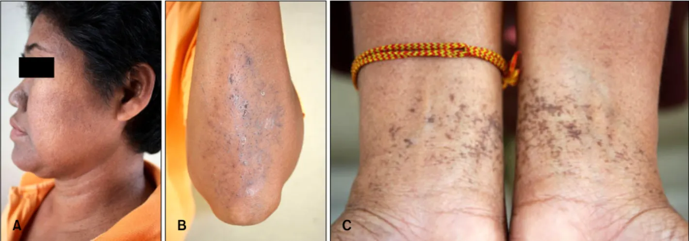 Fig. 2. Skin lesion of proband, 82-year-old man. (A, B) Reticulate hyperpigmentation, multiple pits and comedo-like lesions distributed  over the face, perioral area and neck