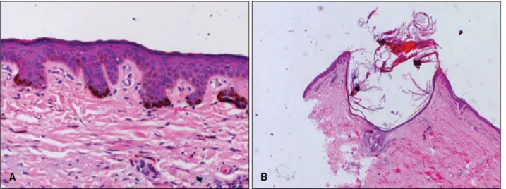 Fig. 5. Skin biopsy specimens from proband of hyperigmented macule (A) and comedo-like lesion (B)