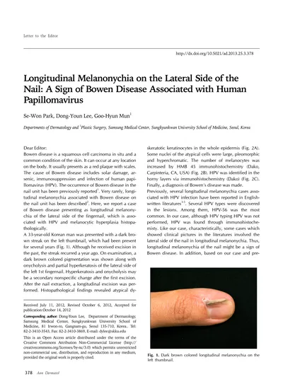 Longitudinal Melanonychia on the Lateral Side of the Nail: A Sign of ...