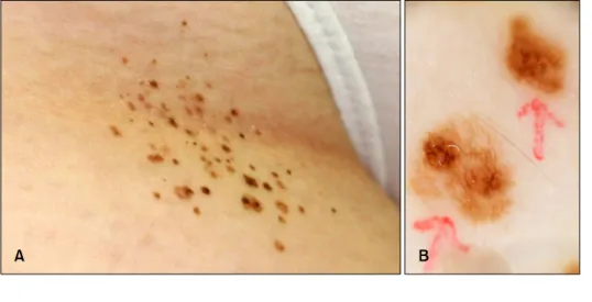 Fig. 1. (A) Asymmetric, multiple,  grouped, irregular, flat, dark  bro-wnish papules and macules on the inguinal area