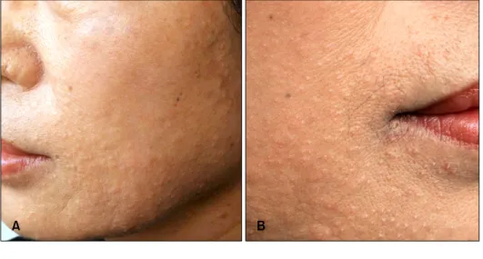 Fig. 1. (A) Multiple 2- to 3-mm-si- 3-mm-si-zed skin-coloured papules  obser-ved on the face and neck