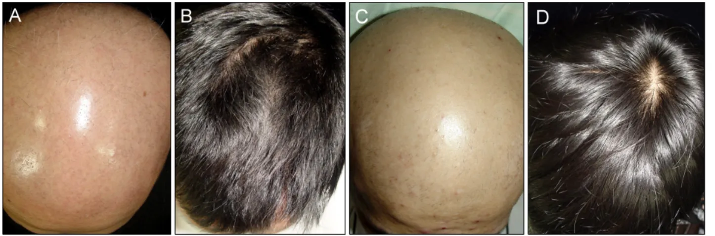 Fig. 1. Photography demonstrating the effect of oral steroid pulse therapy. (A) Severe alopecia areata in a 33-year-old male patient  with only a small amount of hair on the occipital scalp (not shown) for 3 months