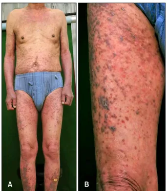 Fig. 1. (A) Symmetrically involved erythematous to violaceous papules and plaques, covered extensive body surface area