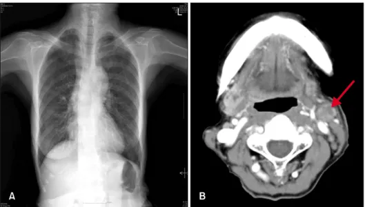 Fig. 4. 1 cm small calcified nodules  on the right upper pulmonary lobe  (A), and peripheral enhancing low  density lesions (arrow) on the left  neck (B)