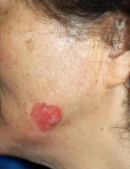 Fig. 1. The erythematous nodule based on an irregular shaped  erythematous patch is seen on the left mandibular angle.
