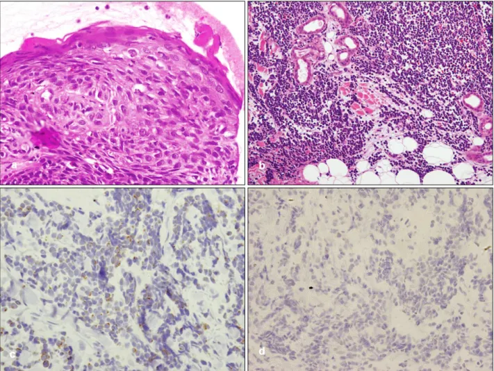 Fig. 2. (a) “Windblown appearance” of the epidermis on the patch lesion (H&amp;E, ×200)