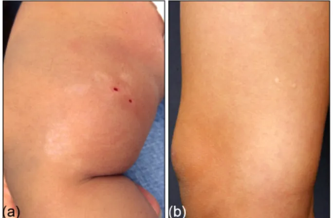 Fig. 1. Spontaneous disappearance of hypopigmented macules  and patches. (a) A 10-month-old male presented with  hypo-pigmented macules and patches on his right thigh in linear  configuration since birth