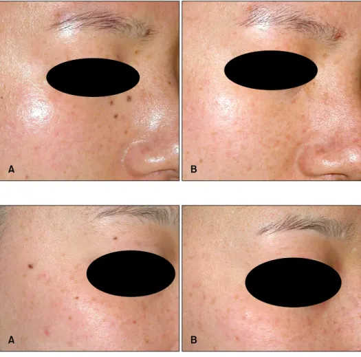 Fig. 2. Results before (A) and after  (B) the Q-switched Nd:YAG laser  (Medlite II, Conbio, Fremont, CA,  USA) treatment.