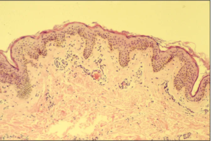 Fig. 3. Histopathology shows numerous dilated thin-walled,  small-sized blood vessels without endothelial proliferation and  vasculitis in the papillary dermis (H&amp;E, ×100).