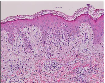Fig. 2. Skin biopsy showing vacuolar changes in the basal layer, and mild perivascular inflammatory cells, including many  eosinophils, infiltrating in the dermis (H&amp;E, ×100).