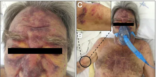 Fig. 1. (A, B) Features of the  cutaneous lesions on the face and  thorax. (C) Highlight of one firm  subcutaneous nodule on the right  arm