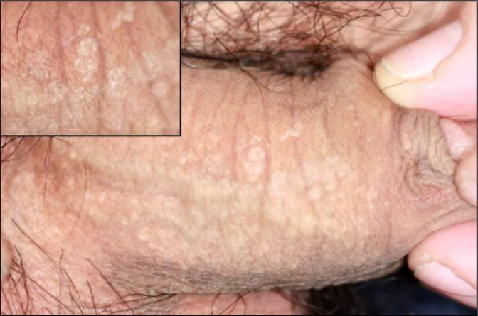 Fig. 1. Several hypopigmented scaly macules on circumcised  penile shaft.