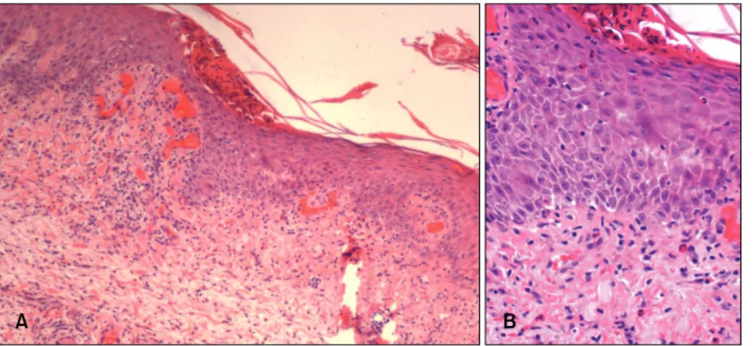 Fig. 2. Moderate dry eczematous changes with no evidence of nodules after 18 weeks of weekly diphencyprone application.
