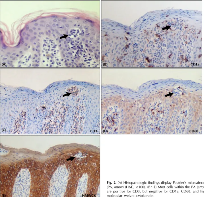 Fig. 2. (A) Histopathologic findings display Pautrier’s microabscess (PA, arrow) (H&amp;E, ×100)