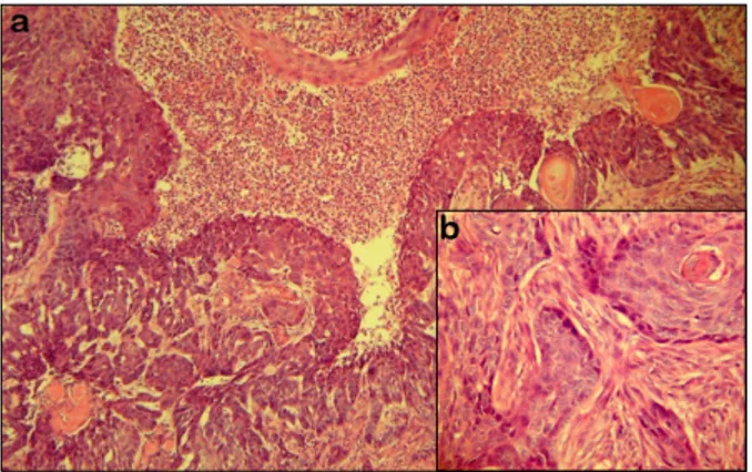 Fig. 1. Well-demarcated large destructive ulcers on the scrotum  and perineal area.