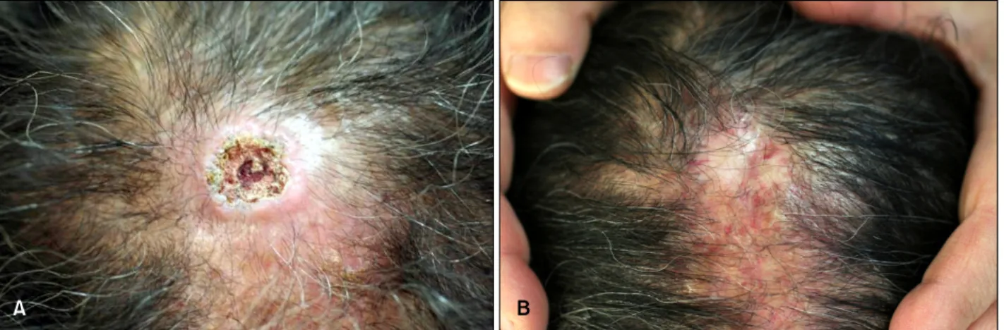 Fig. 1. (A) Before the treatment, there is a walnut-sized central crusted ulcer surrounded by erythematous, elevated indurative border  on the vertex