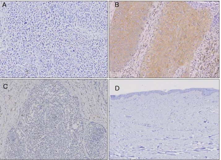 Fig. 2. Immunohistochemical analysis of tripartite motif-containing 29 (TRIM29) expression in (A) malignant melanoma, (B) squamous cell carcinoma, (C) basal cell carcinoma, and (D) normal skin tissue