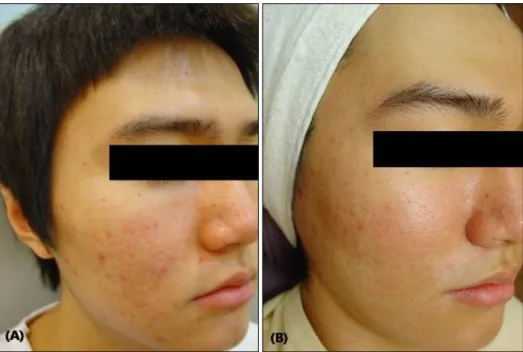 Fig. 1. Photography of patient 6. (A) Before the treatment. (B) Five weeks after the final treatment, acne lesions were cleared.