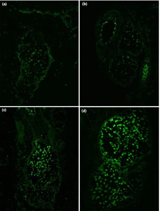 Fig. 3. Apoptotic sebocytes before  (a, b) and after (c, d) photodynamic  therapy, by terminal  deoxynucle-otidyl transferase-mediated  deoxyu-ridine triphosphate nick end-labeling (TUNEL) staining (×400)