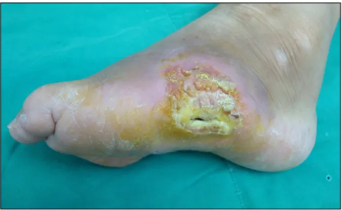 Fig. 1. Multiple, coalescing, firm, flesh-colored nodules asso- asso-ciated with areas of crusting on the left foot