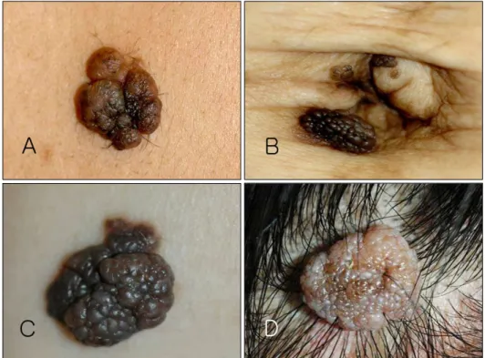 Fig. 1. (A) A brownish to black  lobulated corymbiform tumor with  hair growth, on back