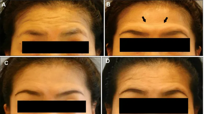 Fig. 1. Case 1: Patient before treatment at maximal forehead wrinkling (A), one week after treatment (B) and at 4 (C) and 16 (D)injection on the forehead was observed in 2 patients