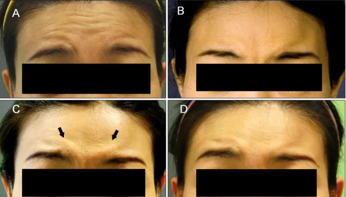 Fig. 2. Case 2: Forehead wrinkling at maximal upward gaze prior to treatment (A), and at 1, 2, and 4 weeks’ follow-up after botulinum toxin treatment (B∼D).
