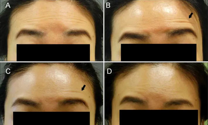 Fig. 4. Case 4: Patient with forehead wrinkling at maximal upward gaze prior to treatment (A), and at 1, 2, and 4 weeks’ follow-up (B∼D).