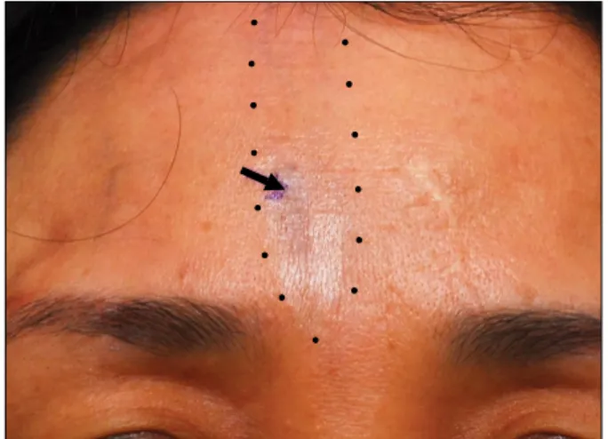 Fig. 1. A linear, well-demarcated atrophic patch on the forehead (black arrow).