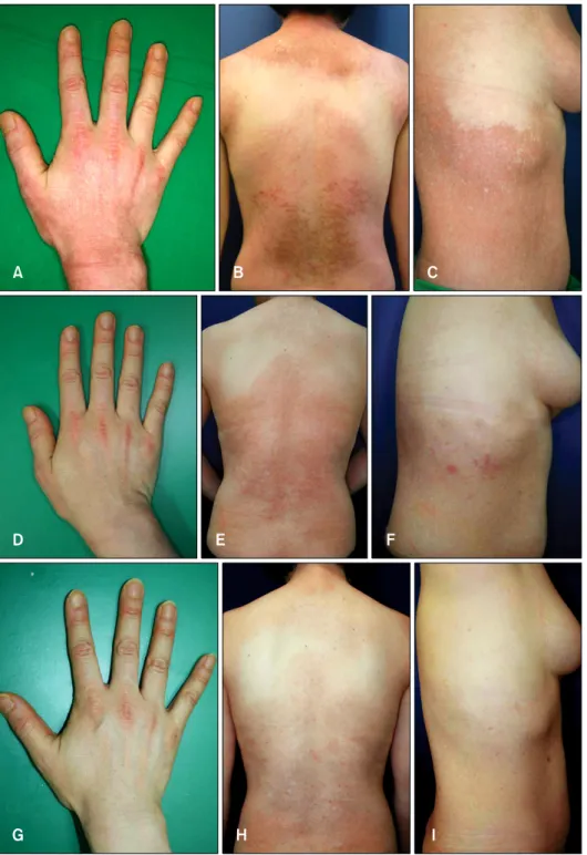 Fig. 2. (A) Patient 2 with the Gottron’s sign before treatment. (B)  Poikiloder-matous erythePoikiloder-matous patch on the  nape and trunk before treatment
