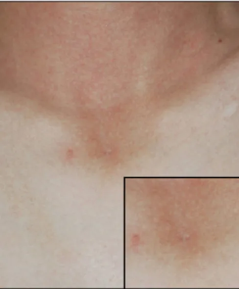 Fig. 1. A slightly erythematous nodule, with central pin-point  sized opening on the suprasternal notch.