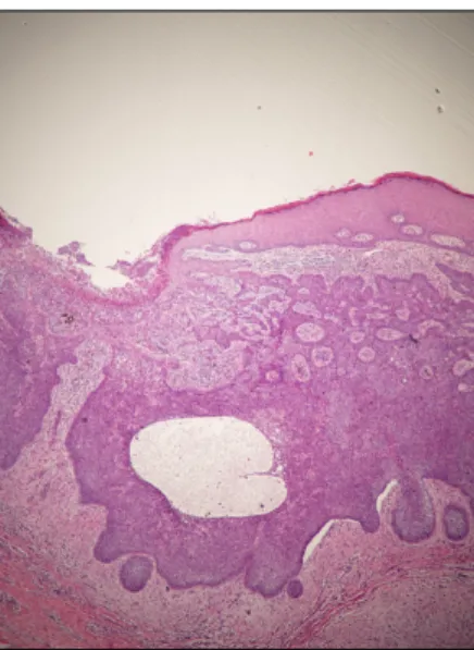 Fig. 1. Brown crusted nodules of various sizes, with a gray patch on the right pubic area.