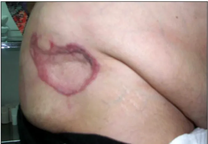 Fig. 3. Two months later, the defect appeared completely healed, with a small depressed scar.