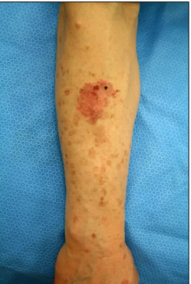Fig. 2. Biopsy specimen obtained from the erythematous plaque on the right arm. In epidermis, acanthosis and dysregulated keratinocytes with hyperchromatic, atypical nuclei are observed.