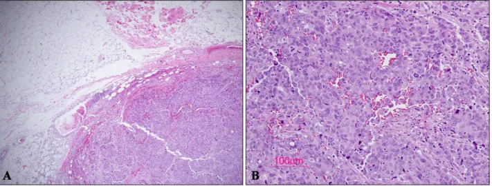 Fig. 1. Skin examination revealed multiple well-demarcated,  skin-colored subcutaneous nodules on the trunk.