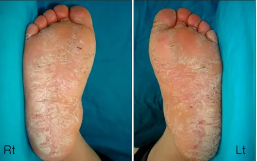 Fig. 1. Thick keratotic scales and  furrows with mild erythema involves  the entire plantar surface bilaterally,  including its lateral borders and  in-terdigital spaces.