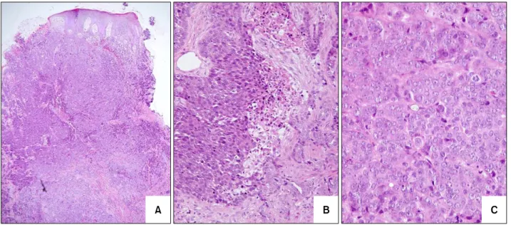Fig. 2. (A) Well-defined tumor nests composed of polygonal or cuboidal cells invade the dermis and subcutaneous fat layer