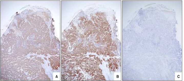 Fig. 3. Immunoperoxidase stain shows positivity for (A) EMA and (B) CK-7, and negativity for (C) CEA.
