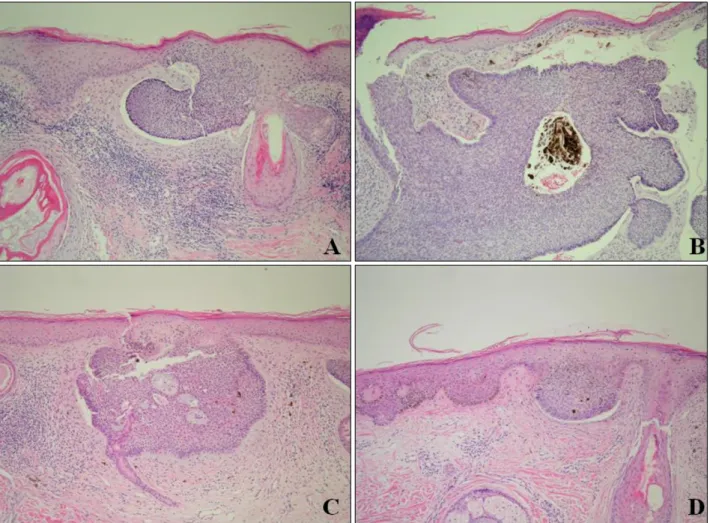 Fig. 2. In satellite lesions from right to left on the scalp. Histopathologic finding showed budding of basaloid cells from the basal layer into the upper dermis, with peripheral palisading and clefting (H&amp;E,×40).