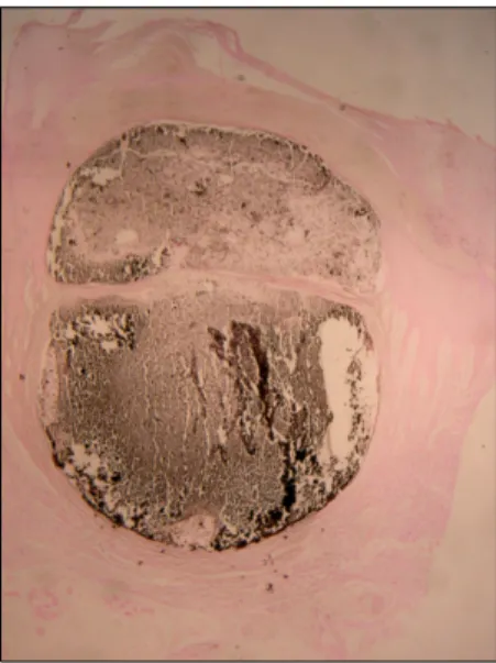Fig. 2. Haematoxylin and eosin-stained sections showed a  hyperkeratotic and acanthotic epidermis overlying a cystic  structure in the upper dermis