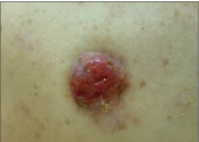 Fig. 1. Photograph of the lesion.  Fig. 3. SLN of the left axilla with metastatic BSC (CK AE1/AE3,