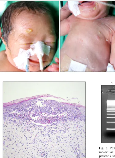 Fig. 1. Yellowish bullous and pu- pu-stular eruptions and desquamation  on the face, trunk, and arms.